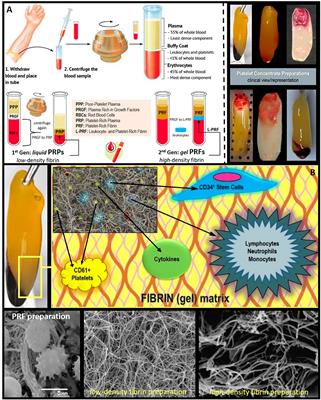 Evidence-Based Clinical Efficacy of Leukocyte and Platelet-Rich Fibrin in Maxillary Sinus Floor Lift, Graft and Surgical Augmentation Procedures